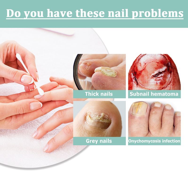 Carlmora™ Nails Repair Pen